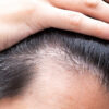 30代男性必見！AGAの初期症状を見逃すな