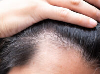 30代男性必見！AGAの初期症状を見逃すな
