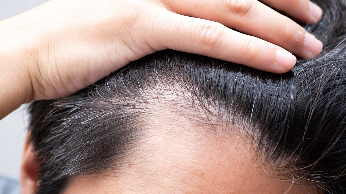 30代男性必見！AGAの初期症状を見逃すな